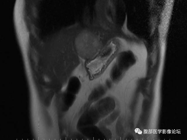 【病例】肝左外叶局灶性结节性增生FNH一例MR 【病例】肝左外叶局灶性结节性增生FNH一例MR