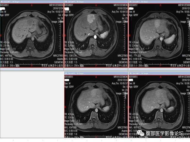 【病例】肝左外叶局灶性结节性增生FNH一例MR 【病例】肝左外叶局灶性结节性增生FNH一例MR