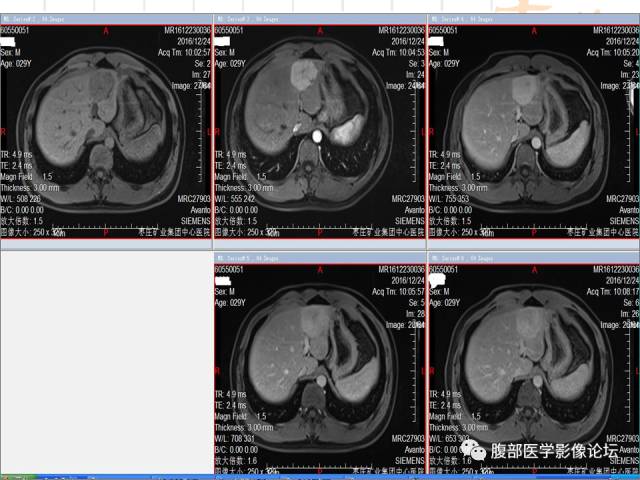【病例】肝左外叶局灶性结节性增生FNH一例MR 【病例】肝左外叶局灶性结节性增生FNH一例MR
