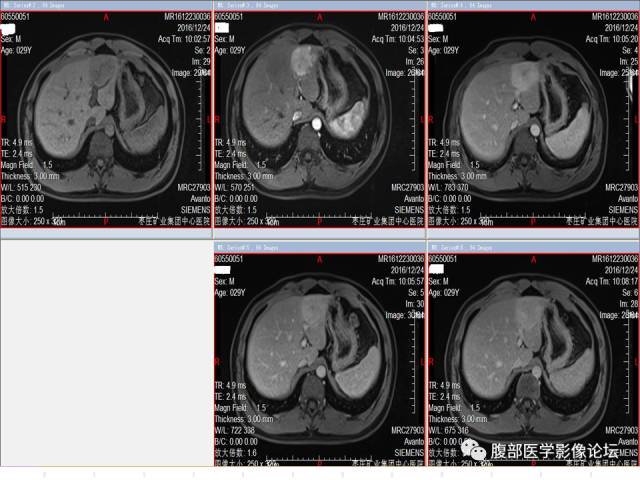 【病例】肝左外叶局灶性结节性增生FNH一例MR 【病例】肝左外叶局灶性结节性增生FNH一例MR