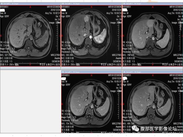 【病例】肝左外叶局灶性结节性增生FNH一例MR 【病例】肝左外叶局灶性结节性增生FNH一例MR