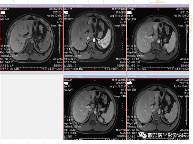 【病例】肝左外叶局灶性结节性增生FNH一例MR 【病例】肝左外叶局灶性结节性增生FNH一例MR
