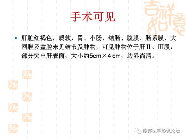 【病例】肝左外叶局灶性结节性增生FNH一例MR 【病例】肝左外叶局灶性结节性增生FNH一例MR