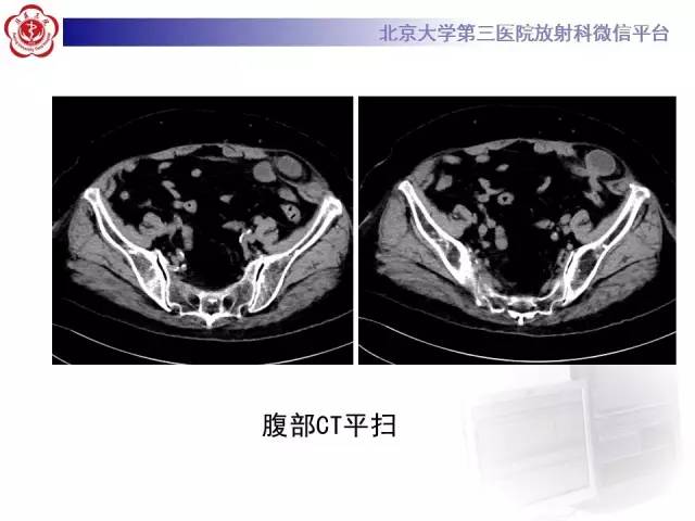 【病例】半月线疝1例CT影像表现