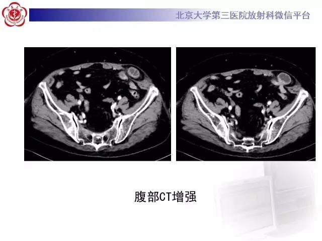 【病例】半月线疝1例CT影像表现