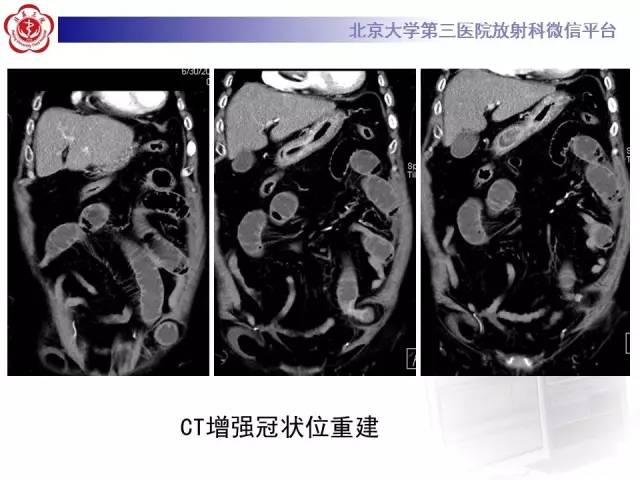 【病例】半月线疝1例CT影像表现