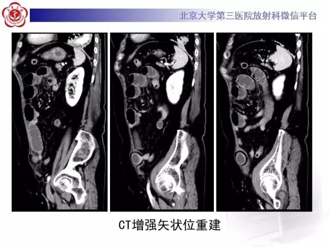 【病例】半月线疝1例CT影像表现