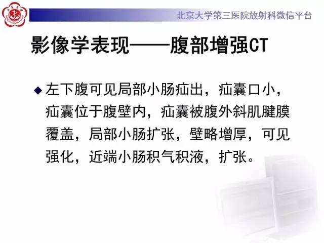 【病例】半月线疝1例CT影像表现