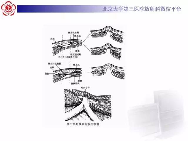【病例】半月线疝1例CT影像表现