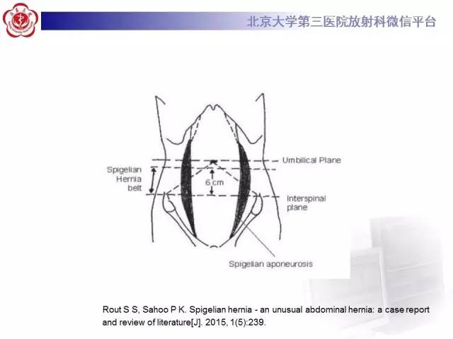 【病例】半月线疝1例CT影像表现