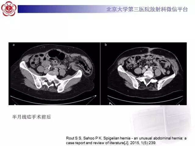 【病例】半月线疝1例CT影像表现