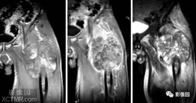 【病例】左大腿上段滑膜肉瘤1例MR影像诊断分析