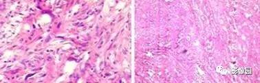 【病例】左大腿上段滑膜肉瘤1例MR影像诊断分析 【病例】左大腿上段滑膜肉瘤1例MR影像诊断分析