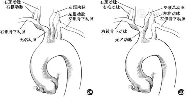牛型主动脉弓畸形影像解析 牛型主动脉弓畸形影像解析