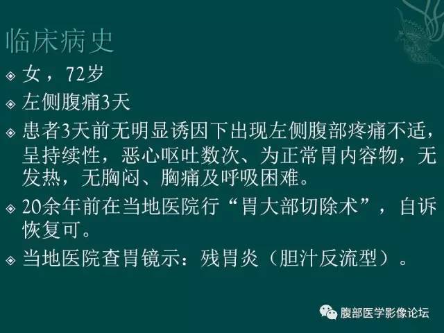 【病例】腹膜后血肿1例MR