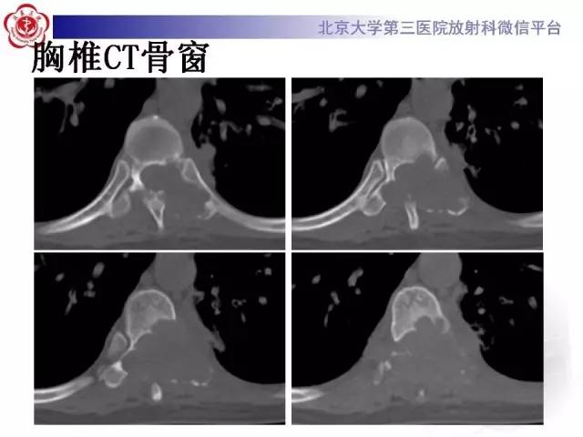 【病例】脊柱神经鞘瘤1例CT及MR