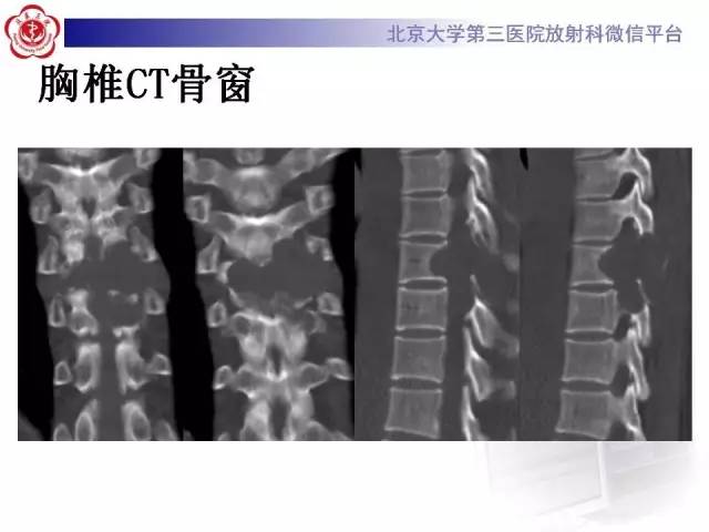 【病例】脊柱神经鞘瘤1例CT及MR