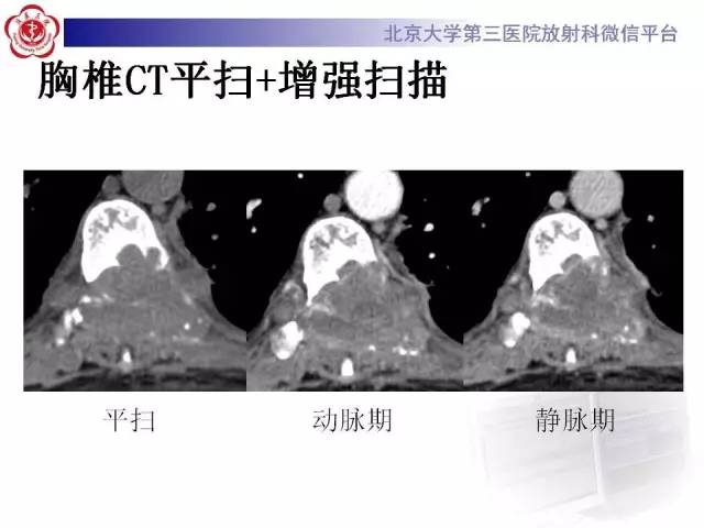 【病例】脊柱神经鞘瘤1例CT及MR