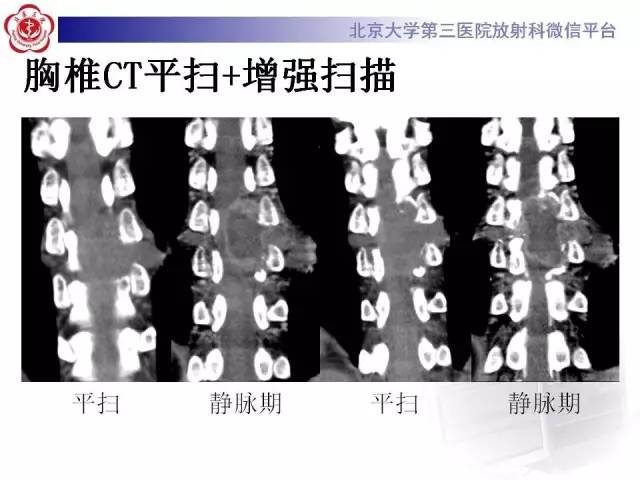 【病例】脊柱神经鞘瘤1例CT及MR