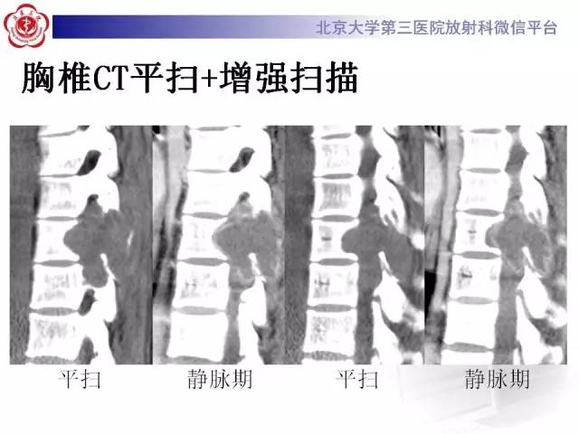 【病例】脊柱神经鞘瘤1例CT及MR