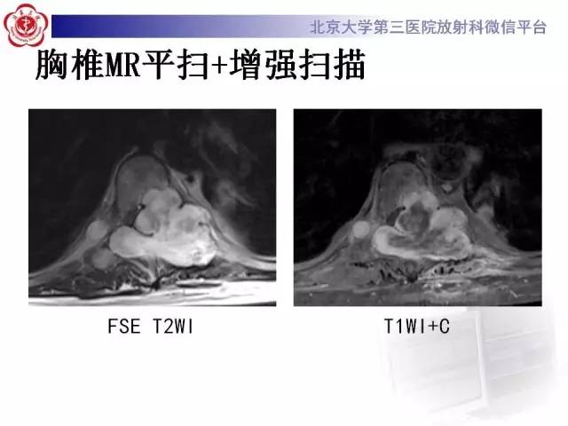 【病例】脊柱神经鞘瘤1例CT及MR