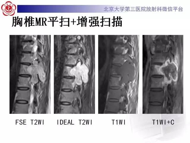 【病例】脊柱神经鞘瘤1例CT及MR