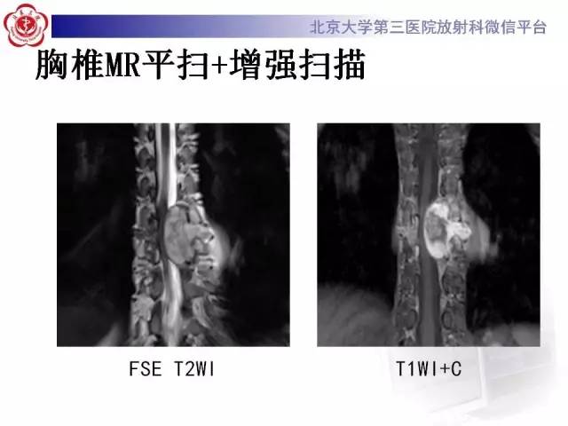 【病例】脊柱神经鞘瘤1例CT及MR