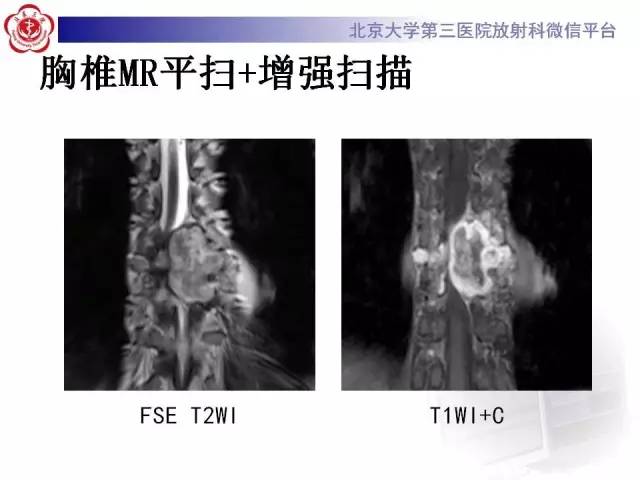 【病例】脊柱神经鞘瘤1例CT及MR