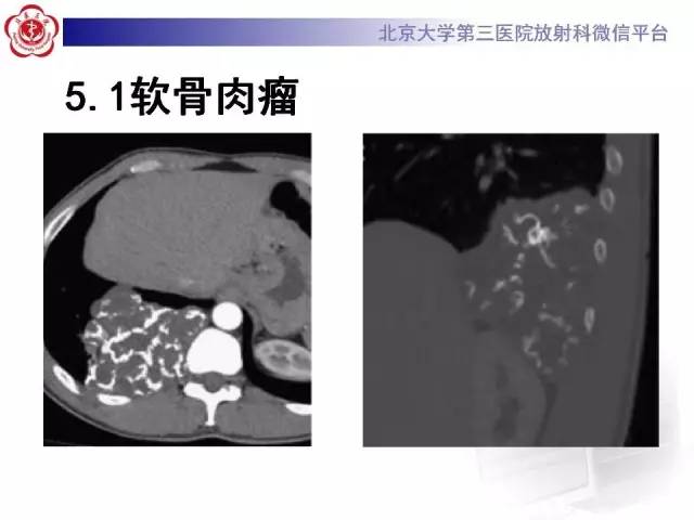 【病例】脊柱神经鞘瘤1例CT及MR