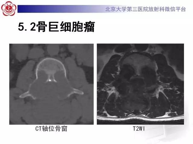 【病例】脊柱神经鞘瘤1例CT及MR