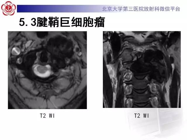 【病例】脊柱神经鞘瘤1例CT及MR