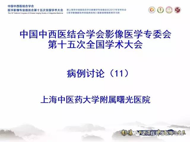 【病例】中枢神经系统淋巴瘤1例MR