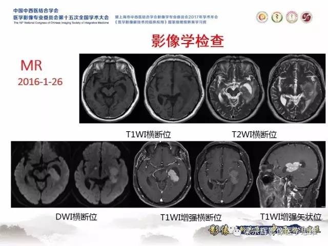 【病例】中枢神经系统淋巴瘤1例MR