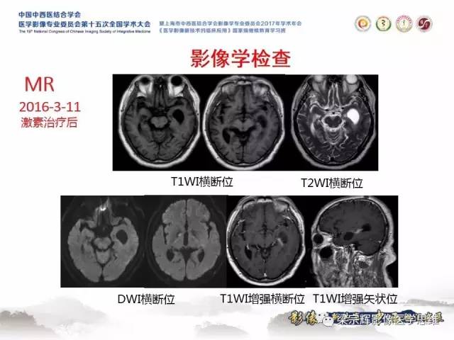 【病例】中枢神经系统淋巴瘤1例MR