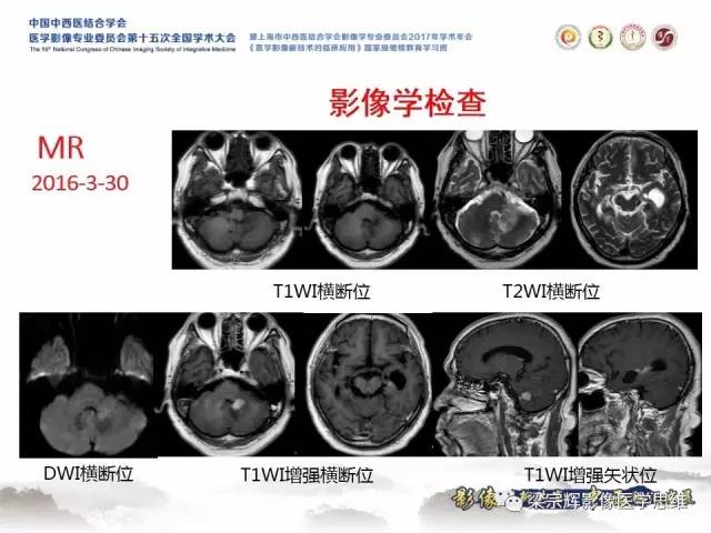 【病例】中枢神经系统淋巴瘤1例MR