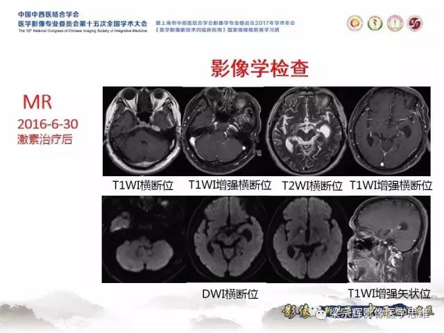 【病例】中枢神经系统淋巴瘤1例MR