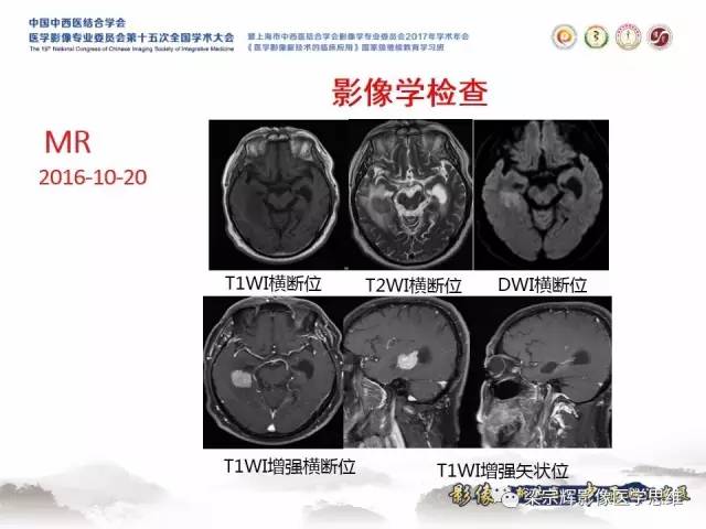 【病例】中枢神经系统淋巴瘤1例MR