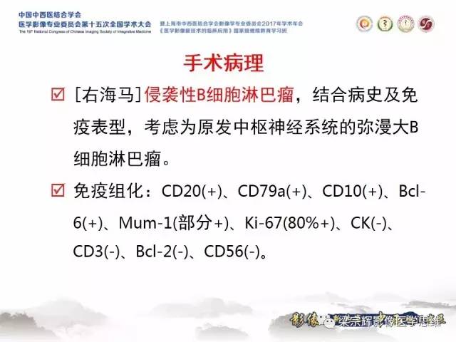 【病例】中枢神经系统淋巴瘤1例MR