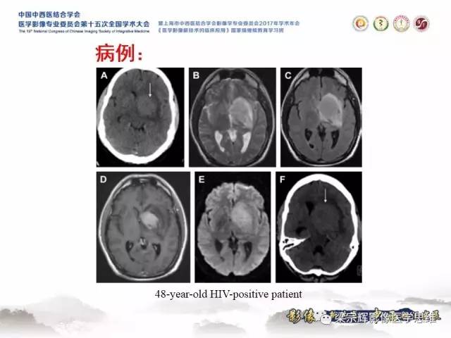 【病例】中枢神经系统淋巴瘤1例MR