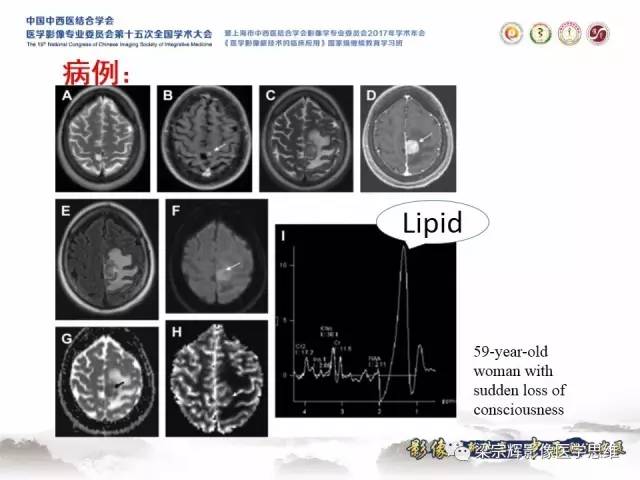 【病例】中枢神经系统淋巴瘤1例MR