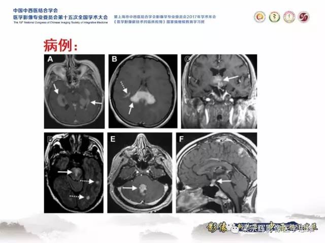 【病例】中枢神经系统淋巴瘤1例MR