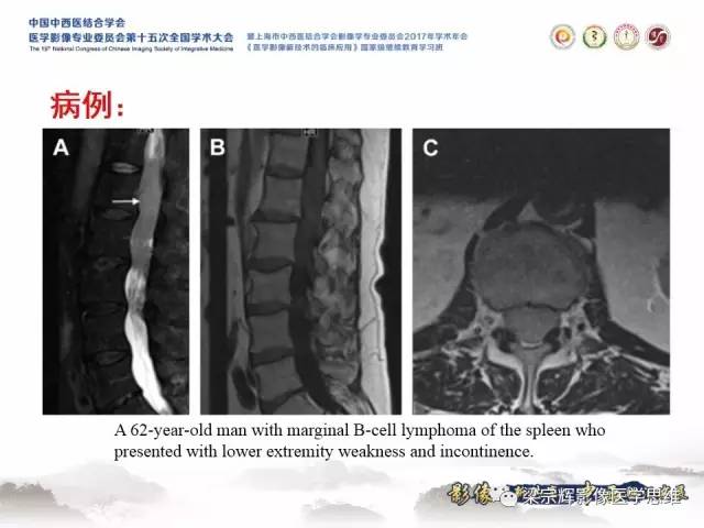 【病例】中枢神经系统淋巴瘤1例MR