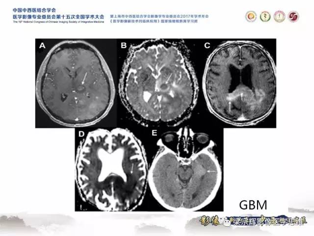 【病例】中枢神经系统淋巴瘤1例MR