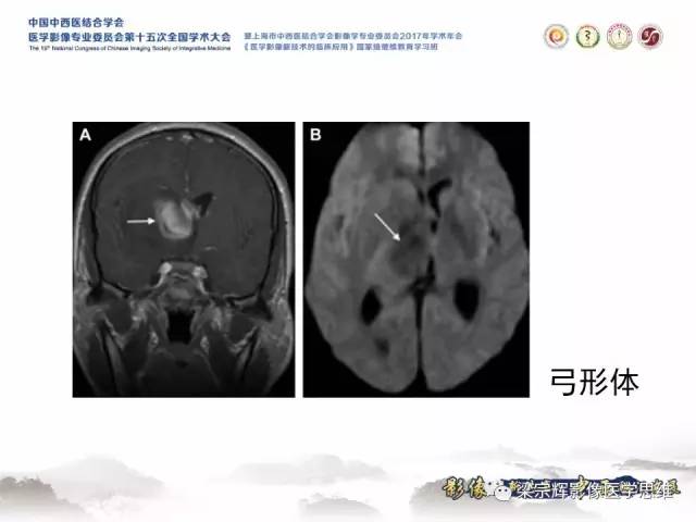【病例】中枢神经系统淋巴瘤1例MR