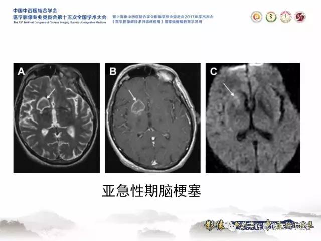 【病例】中枢神经系统淋巴瘤1例MR