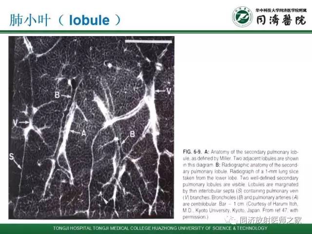 【PPT】间质性肺疾病的影响学表现