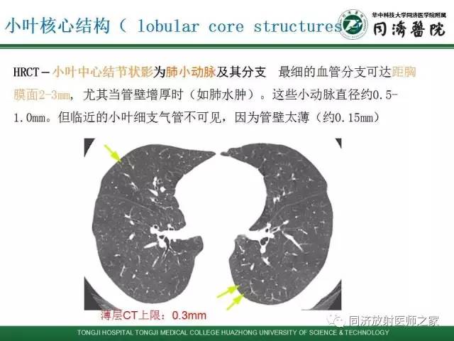 【PPT】间质性肺疾病的影响学表现