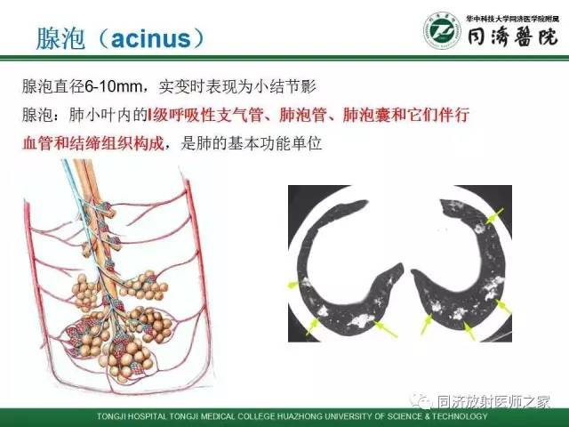 【PPT】间质性肺疾病的影响学表现
