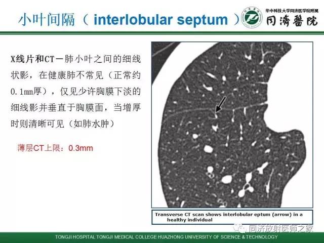 【PPT】间质性肺疾病的影响学表现