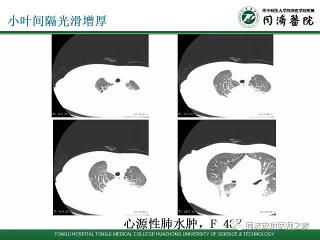 【PPT】间质性肺疾病的影响学表现